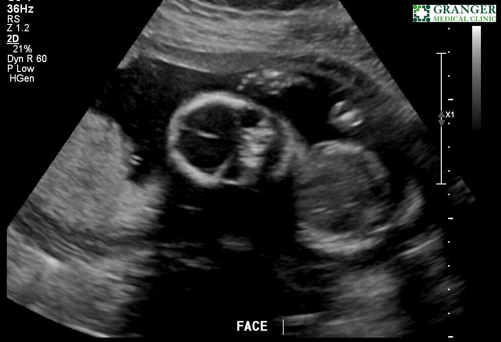 Face ultrasound March 24